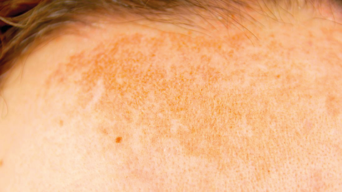 mens pigmentation skin