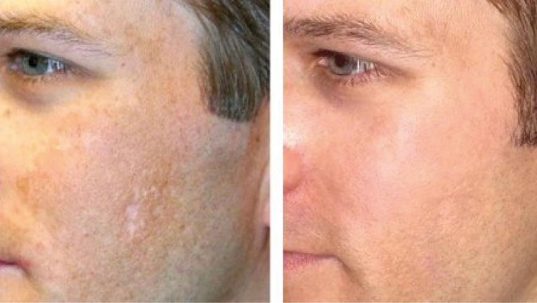 Microneedling for Men