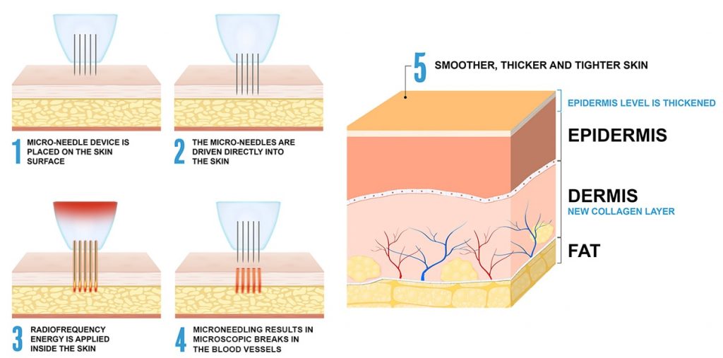 Micro Needling For Men