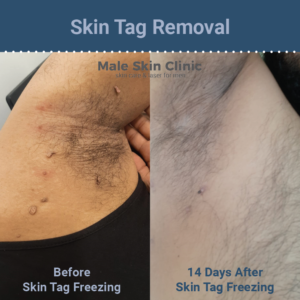 Body Skin Tag Removal