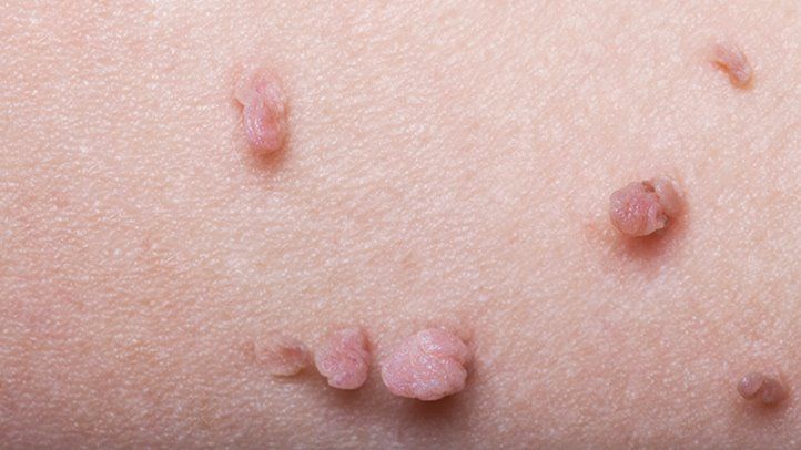 skin tag on groin and arms