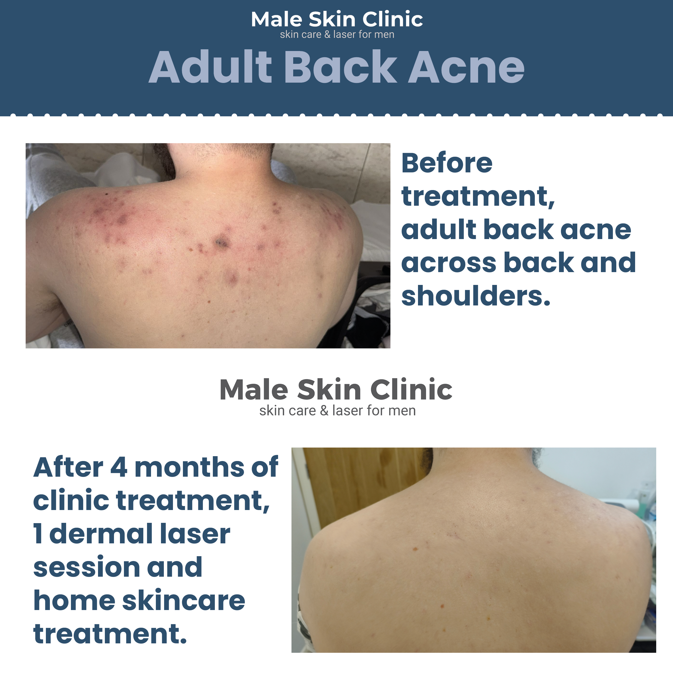 Body Skin Tag Removal