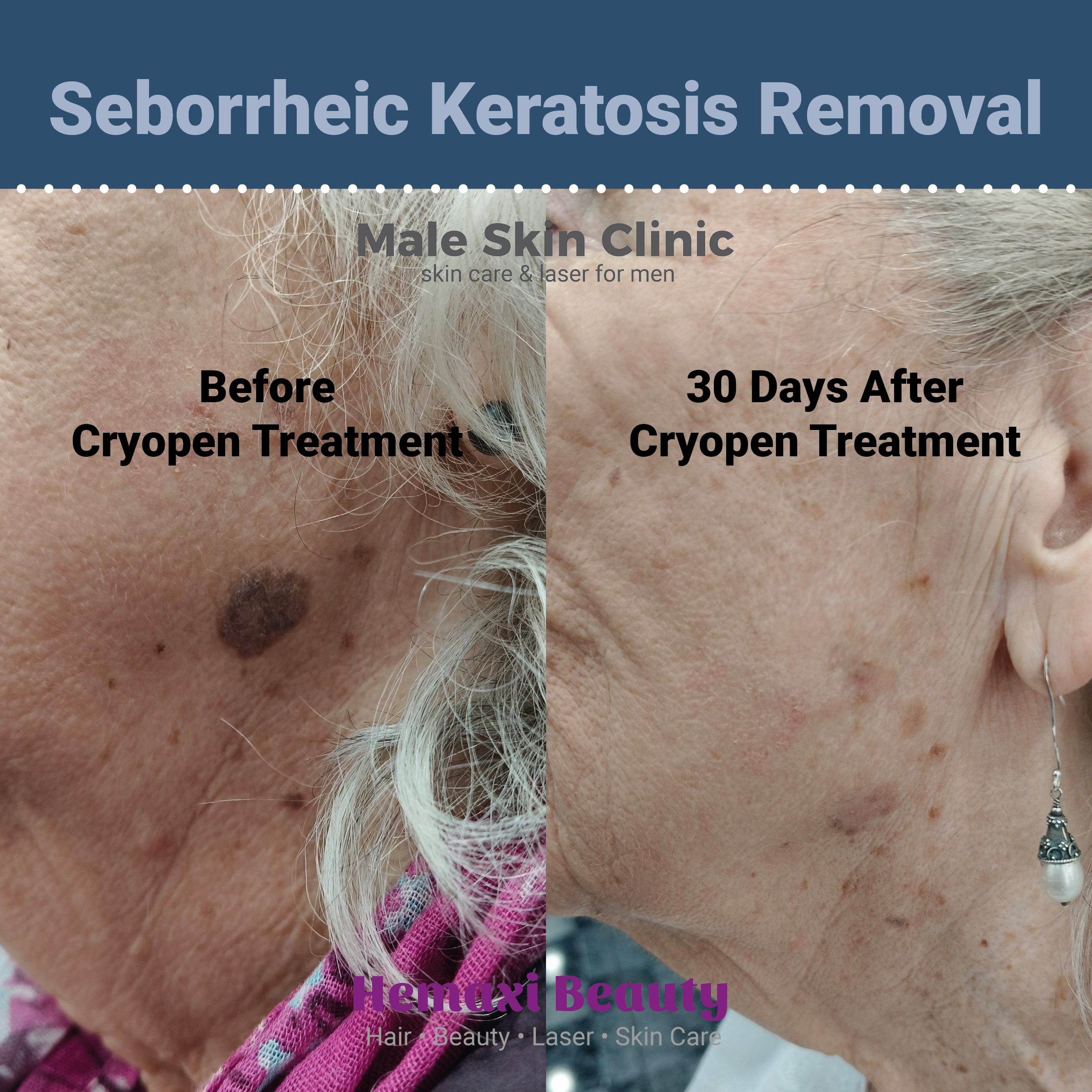 Seborrheic keratosis removal cryotherapy