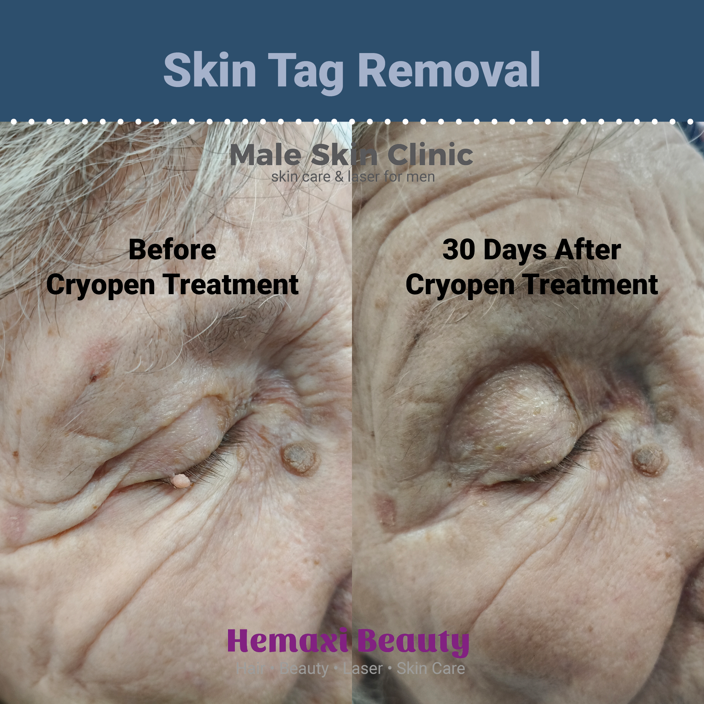 eyelid skin tag removal 
